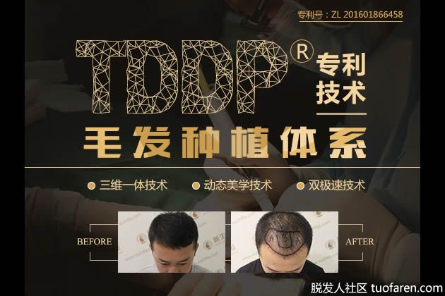 【圖】新生植髮：植髮價格，決定植髮價格的因素