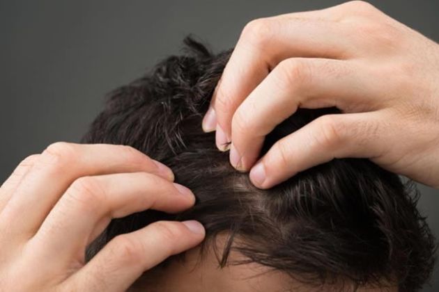 【圖】自然地處理頭皮屑