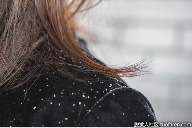 【圖】頭皮屑和脱髮