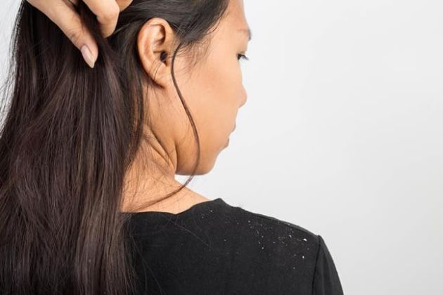 【圖】頭皮屑的原因