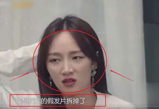 【圖】假髮片都救不了孟佳？如何解決脱髮問題