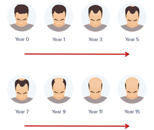 【圖】15年後你會禿頂嗎?