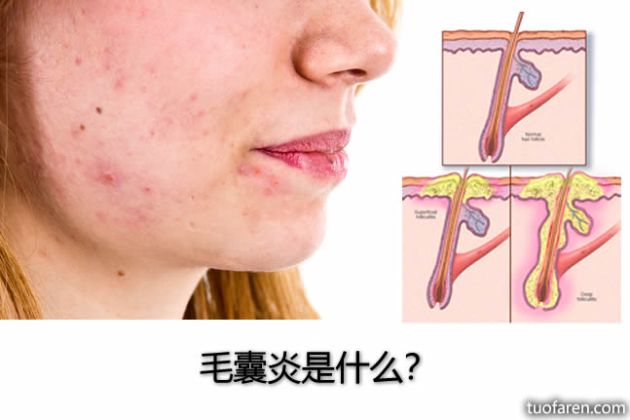 【圖】毛囊炎是什麼？