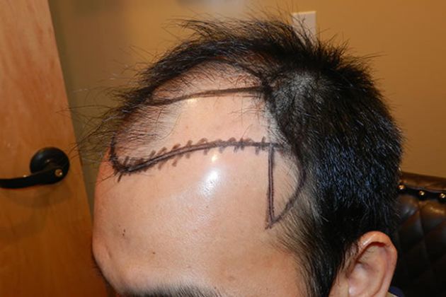 【圖】瞭解前額脱髮