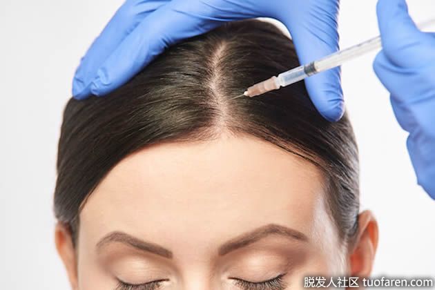 【圖】富血小板血漿用於脱髮