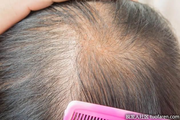 【圖】頭髮稀疏的原因