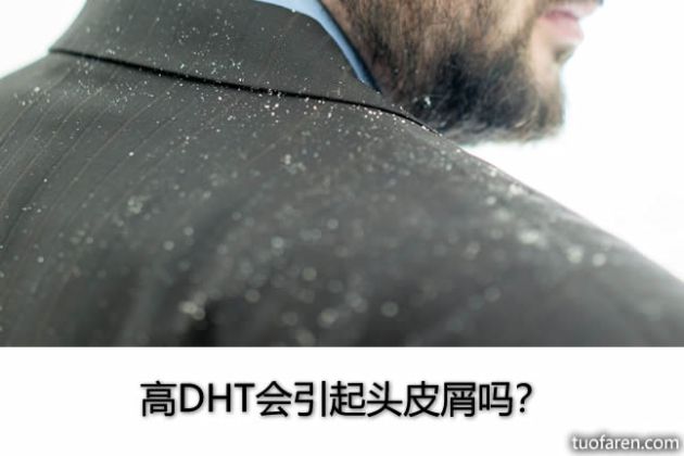 【圖】高DHT會引起頭皮屑嗎？