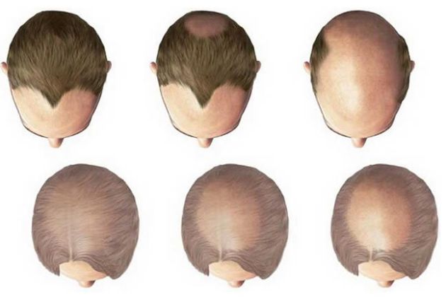 【圖】雄激素性脱髮的病因及治療