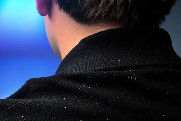 【圖】治療男性頭皮屑的方法