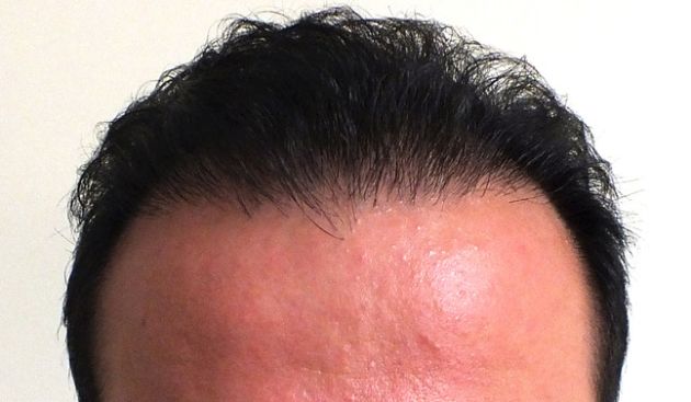 【圖】髮際痤瘡原因、治療、預防