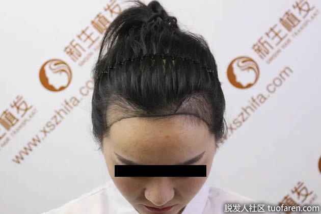 【圖】新生植髮效果：女神植髮真實恢復過程!