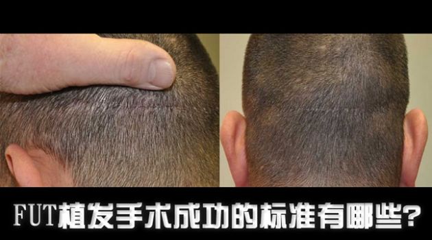 【圖】FUT植髮手術成功的標準有哪些？