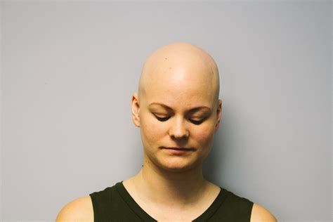 【圖】禿頭症的症狀、原因、治療