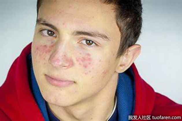 【圖】是什麼導致了充血的丘疹？