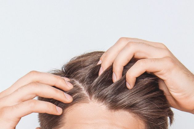 【圖】頭皮屑有哪些不同類型?