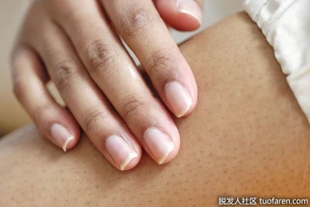 【圖】FUCIDINE H CREAM(夫西地酸乳膏)有什麼作用？