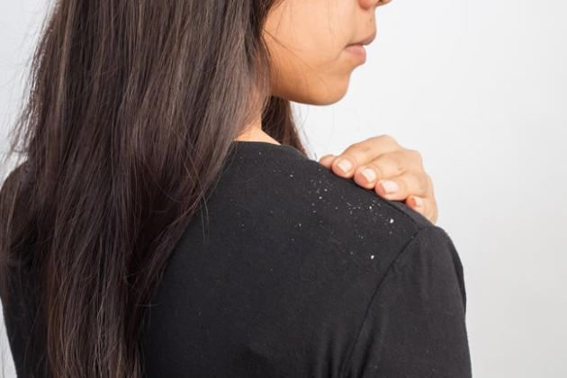 【圖】天然的方法可以減少頭皮屑