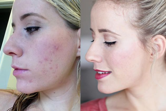 【圖】我怎樣處理油性皮膚?