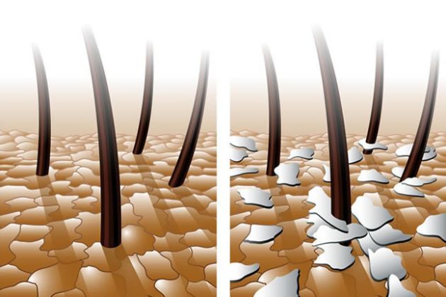 【圖】天然療法可快速有效地防止脱髮，頭皮屑