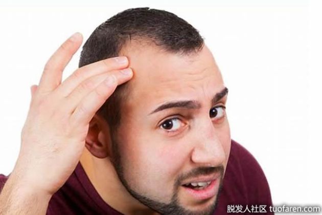 【圖】關於禿頭你瞭解多少