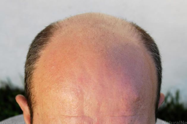 【圖】男性型脱髮與前列腺癌的發生有關