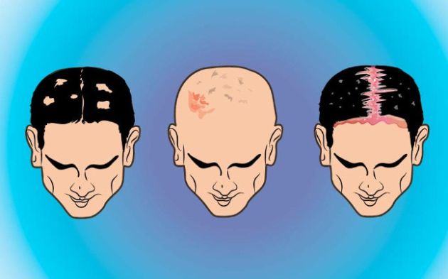 【圖】怎樣治療男性頭皮乾燥