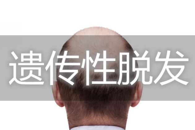 【圖】遺傳性脱髮問題的治療