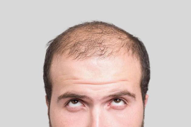 【圖】瞭解科學：最好的脱髮治療方法