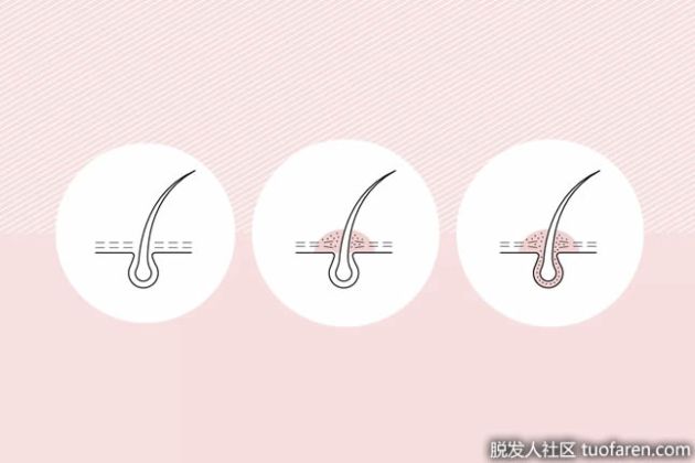 【圖】毛囊炎症狀是什麼，毛囊炎怎麼治療？