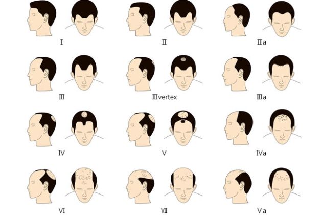 【圖】大多數男人仍然不瞭解脱髮是可逆的！