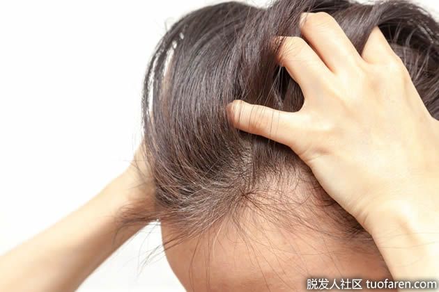 【圖】頭皮發癢是什麼原因
