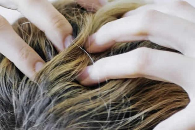 【圖】什麼導致頭皮發癢和脱髮?