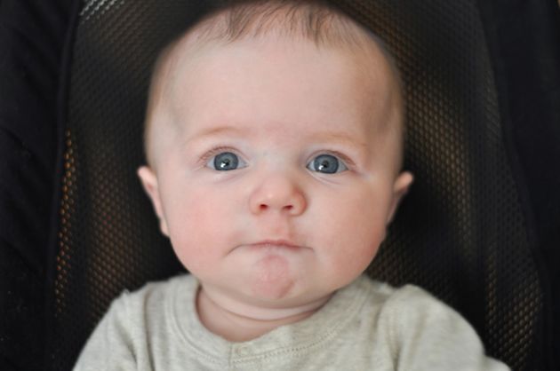 【圖】嬰兒的髮際線後退