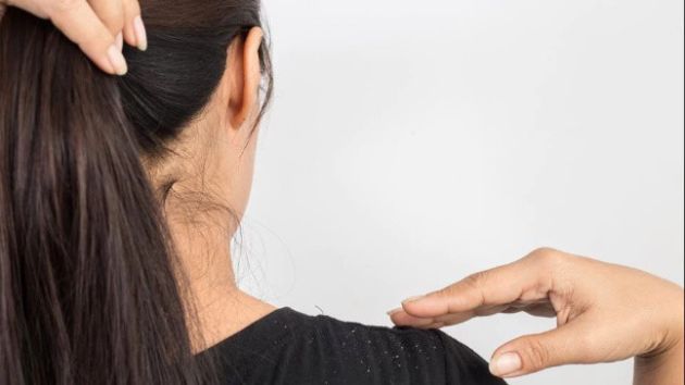 【圖】去除頭皮屑的自然方法