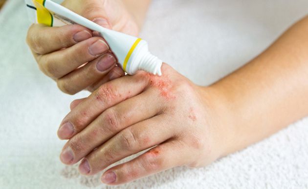 【圖】癬能持續多久？