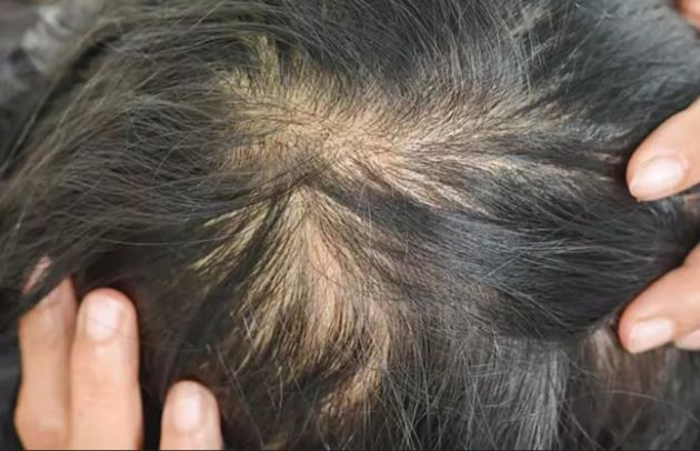 【圖】碘缺乏引起脱髮的症狀