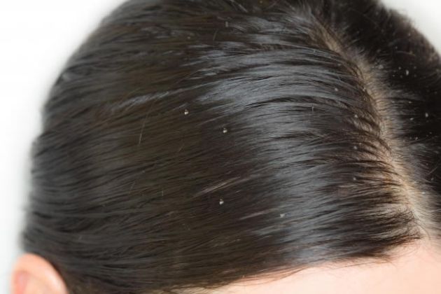 【圖】怎樣才能治療頭皮發癢和頭皮屑?