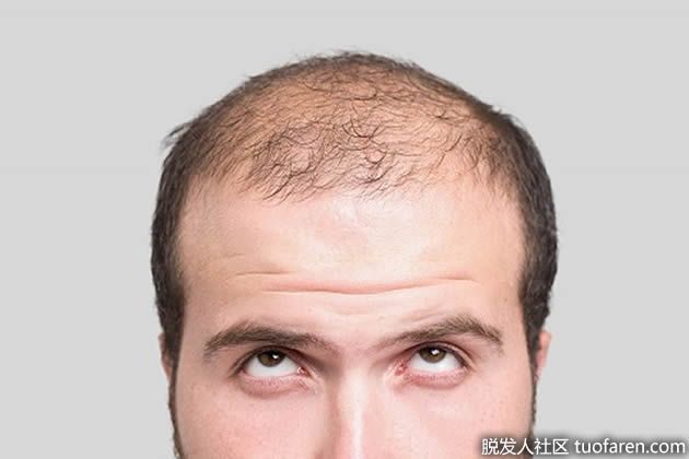 【圖】睾丸激素如何影響脱髮