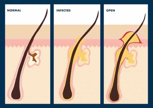 【圖】如何治療發炎的毛囊