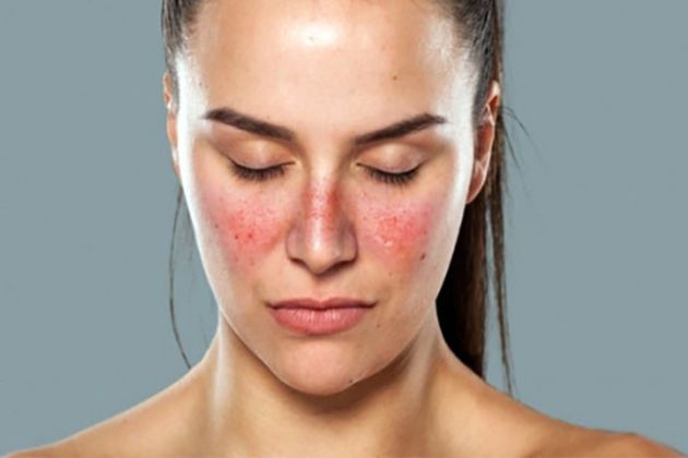 【圖】狼瘡和脱髮之間有什麼聯繫?