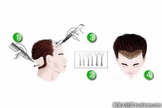 【圖】毛髮移植有副作用嗎