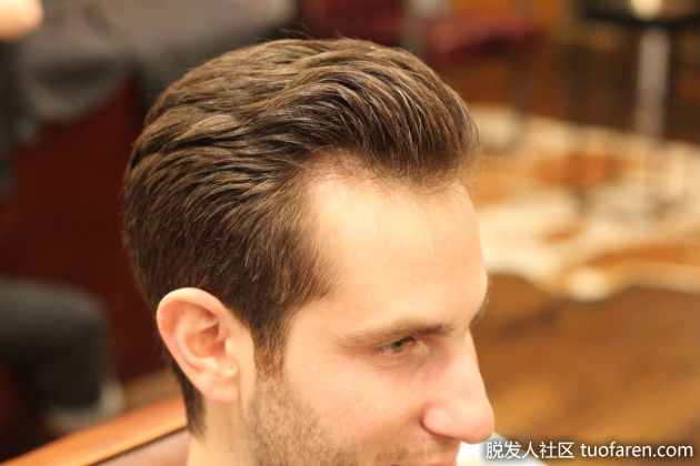 【圖】鬢角種植一般多少錢？