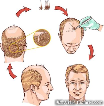 【圖】植髮後頭髮要多久才能長出來啊?