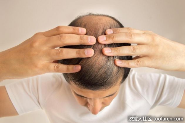 【圖】男性禿頭的2個常見危險因素