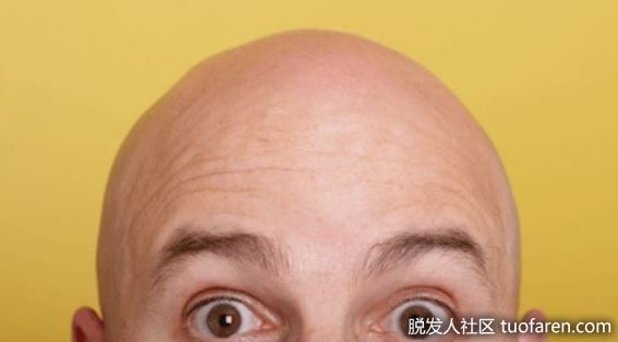 【圖】你應該知道的4種禿頂治療方法