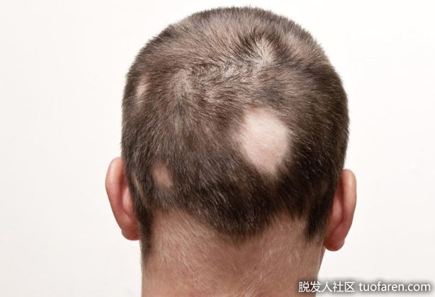 【圖】揭穿5種治療斑禿的誤區