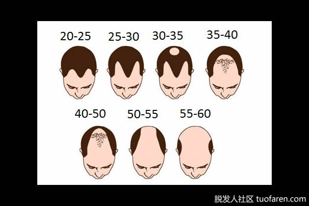 【圖】男性脱髮遺傳學：有什麼方法可以預測脱髮嗎？