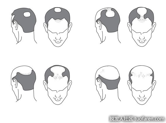 【圖】雄激素性脱髮的原因是什麼？