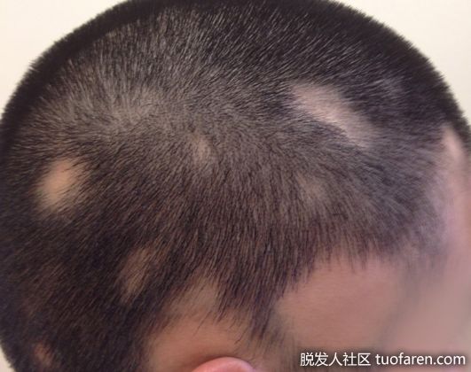 【圖】是什麼使斑禿的症狀不同於其他形式的脱髮？