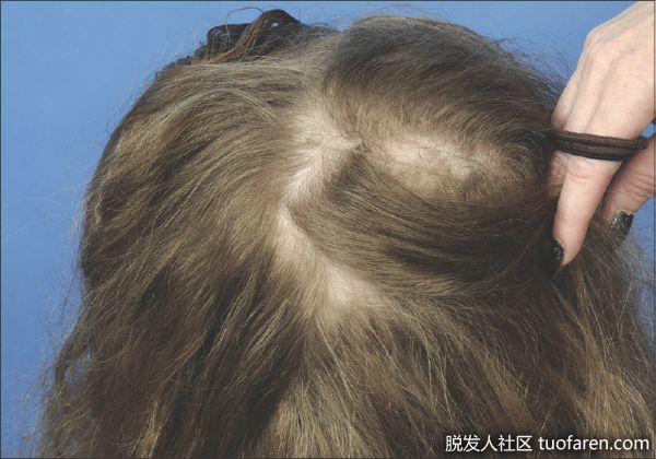 【圖】疤痕性脱髮的治療